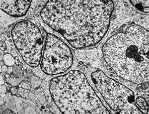 F,8y. | medulloblastoma